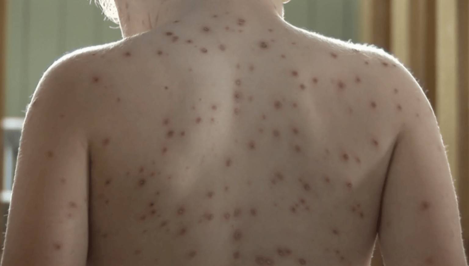 Les maladies courantes en anglais - AnglaisCours Club